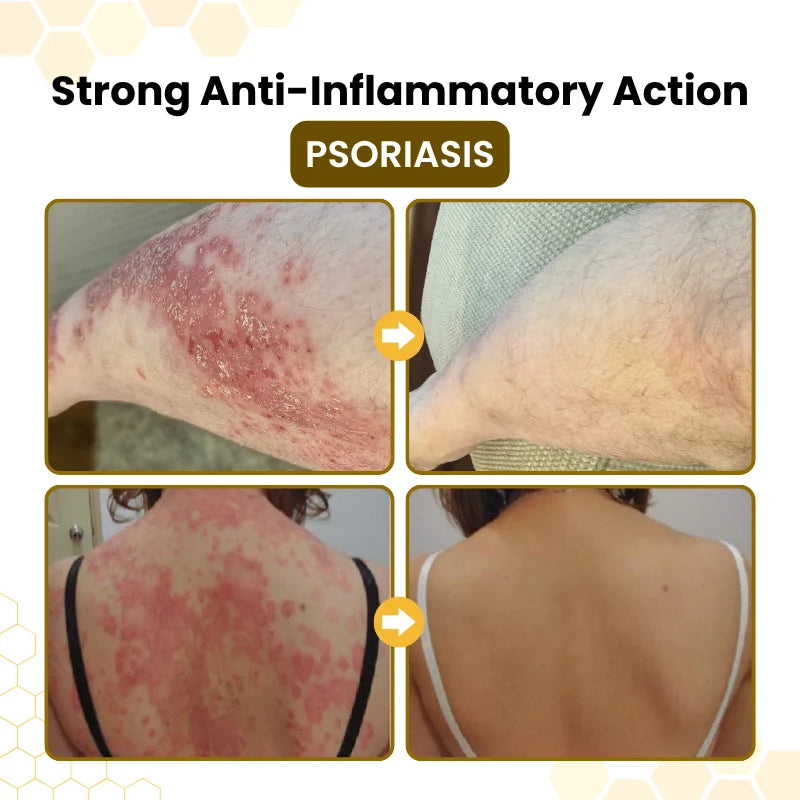 Ximonth® PsoriaSoothe Skin Care Cream