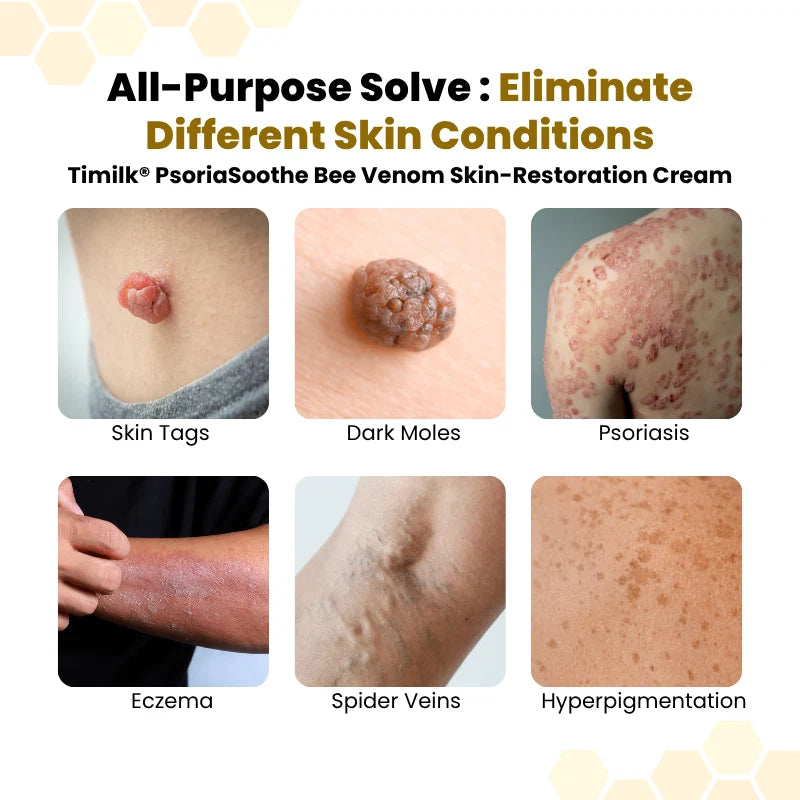 Ximonth® PsoriaSoothe Skin Care Cream