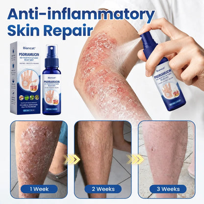 Biancat® PsoriaMucin No-Rub Itch & Flake Relief Mist